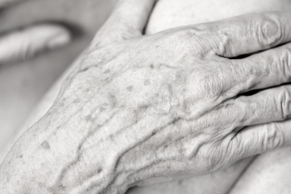 Age Spots removal on the hands by cryosonic Letchworth