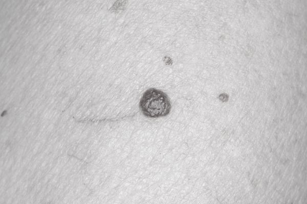 Cherry Angioma Post-Treatment Care for Best Results Letchworth