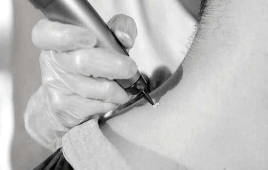 Benign Mole Possible Reactions and How Common They Are Letchworth
