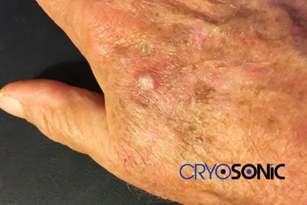 Book Your Actinic Keratosis removal Letchworth treatment Today Letchworth