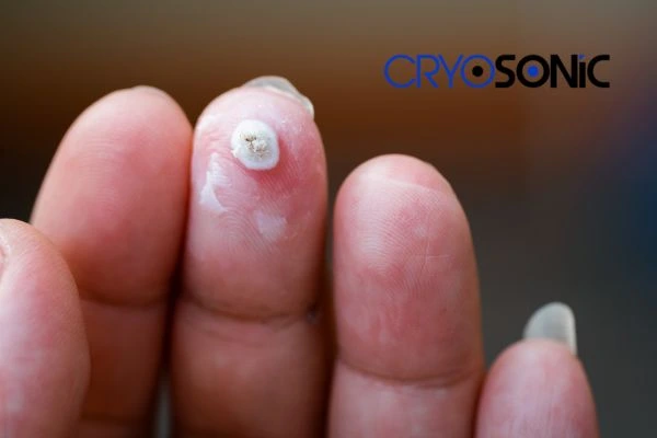 Learn more about us Letchworth at Cryosonic. Book in today! Letchworth