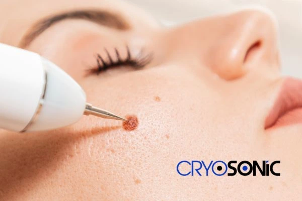 why choose us at Cryosonic for blemish removal? Find out more now Letchworth