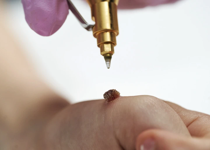 Cryopen For Children Bristol Letchworth
