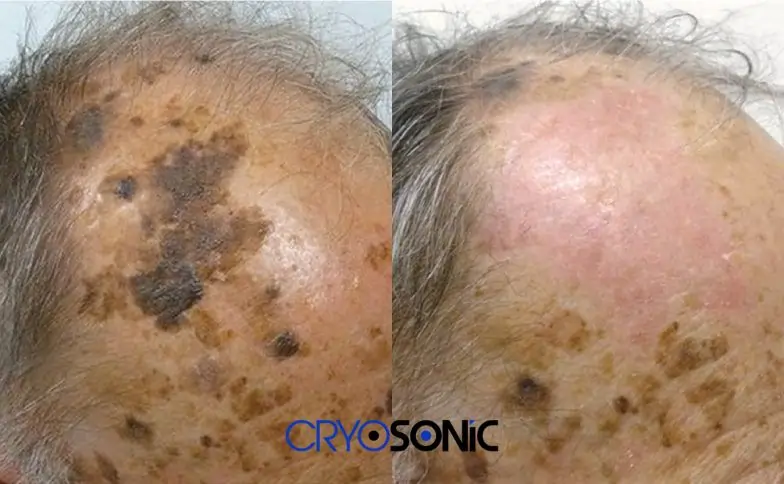 Seborrhoeic Keratosis Removal before and after Letchworth