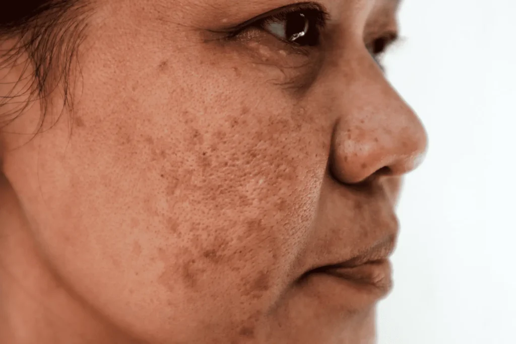 Aftercare Advice for Sun Damage Treatment Letchworth
