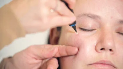 Aftercare Advice Following Milia Removal in Letchworth