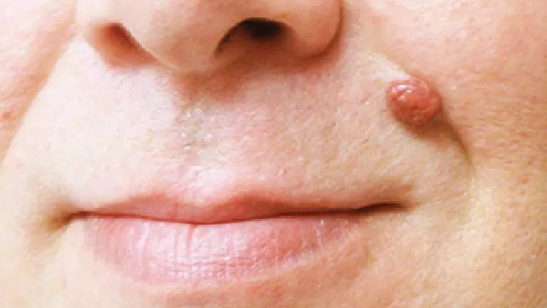 Are There Any Side Effects After removing the Skin Tags? Letchworth