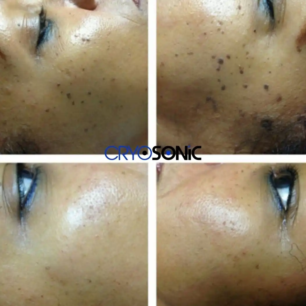 Why Skin Shows Pigmentation After Treatment Letchworth