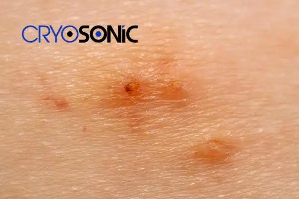 Image of Molluscum Contagiosum Treatment Letchworth Letchworth