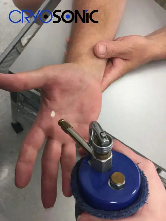 Temperature Differences: OTC vs Medical-Grade Cryotherapy Letchworth